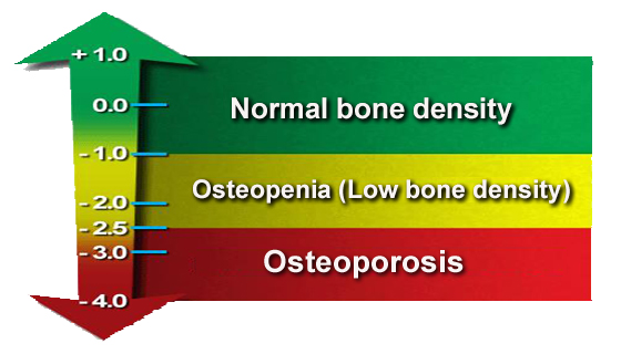 Bone Density Chart: Understand Your Bone Density Scores