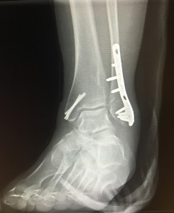 broken ankle front view