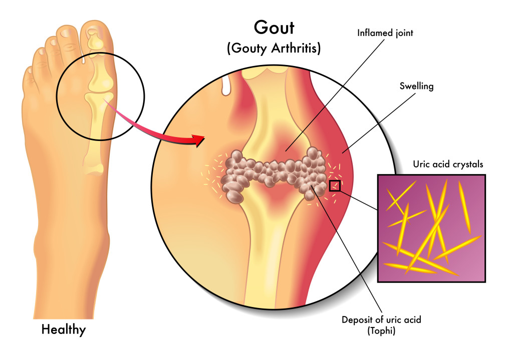 Gout pain in toe