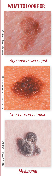 How To Tell If That Spot May Be Skin Cancer Sense Of Urgency