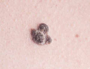 age spots--melanoma