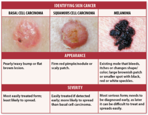 skin cancer signs