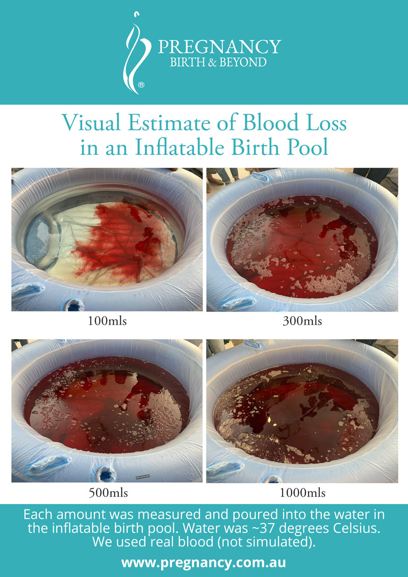 Estimating blood loss at birth
