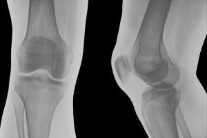A knee x-ray shown from front and side views.