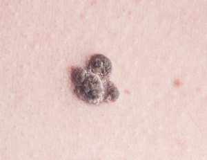 age spots--melanoma